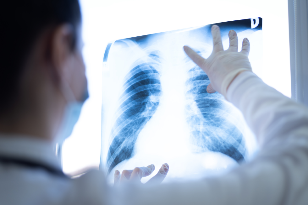Tumore al polmone, nasce una rete di screening per la diagnosi precoce